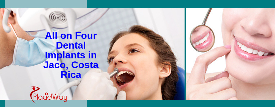 All on 4 Dental Implants Cost in Jaco, Costa Rica